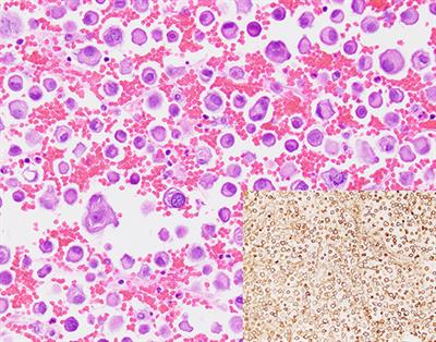 Next-Generation Sequencing of Cell-Free DNA Extracted From Pleural Effusion Supernatant: Applications and Challenges